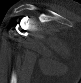 CT Acromial Stress Fracture Reverse TSR 2